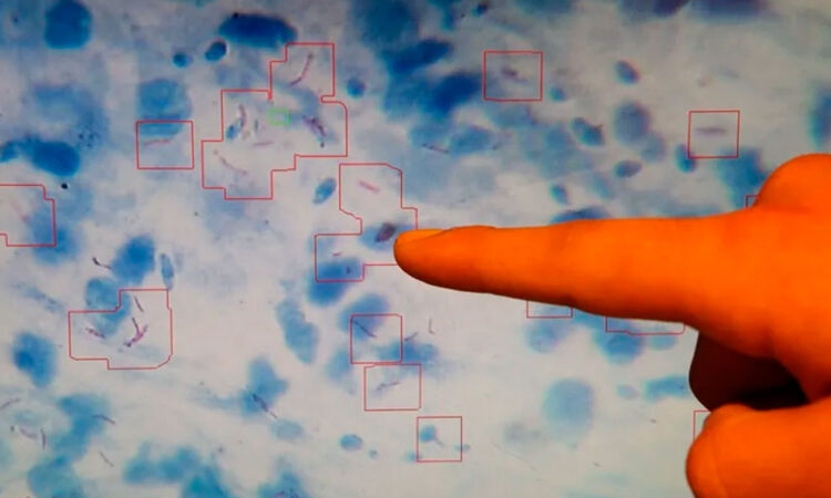 La tuberculosis vuelve a ser la principal causa de muerte infecciosa