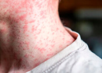 Detectan 58 casos de sarampión en Texas, la mayoría en no vacunados