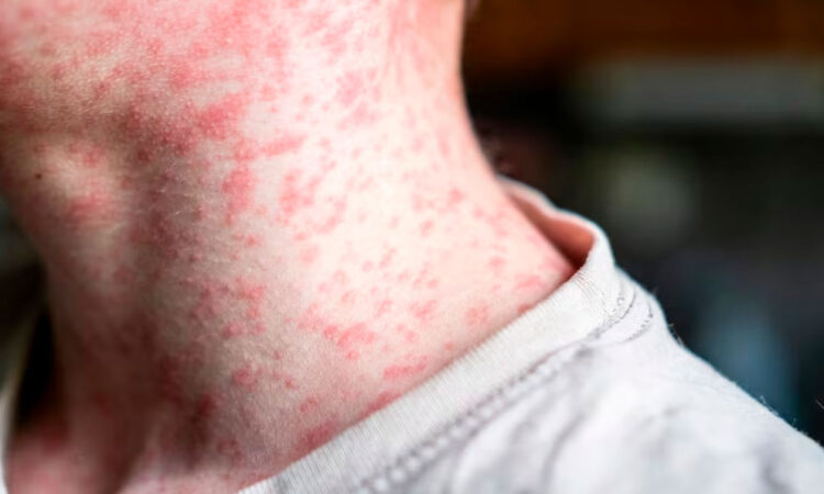 Detectan 58 casos de sarampión en Texas, la mayoría en no vacunados