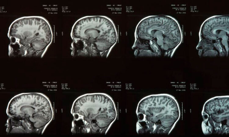 ONU propone crear neuroderechos para proteger la privacidad mental de las personas