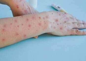 La viruela del mono se propaga rápidamente en el país: 28 casos reportados