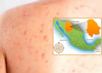 Tragedia en Chihuahua: Primera muerte por sarampión en México