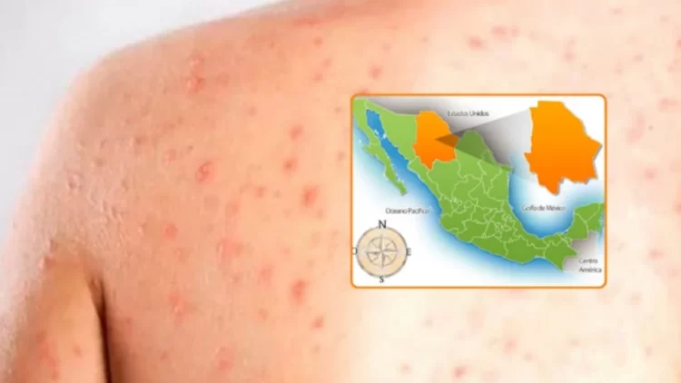 Tragedia en Chihuahua: Primera muerte por sarampión en México