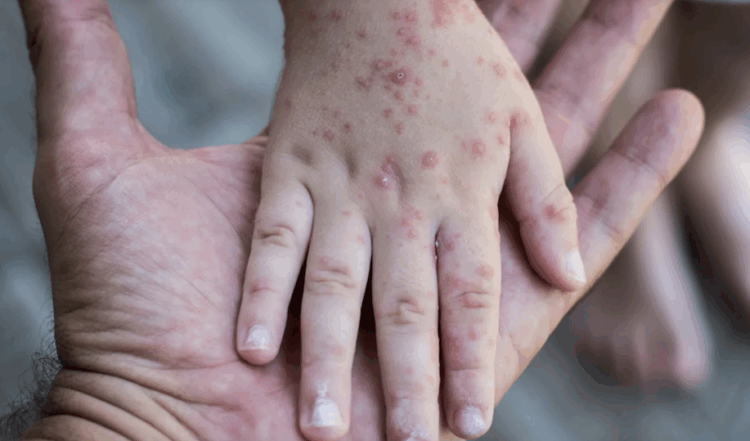 Aumentan a seis los casos de sarampión