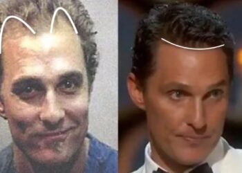 Famosos que se han realizado la cirugía de cabello