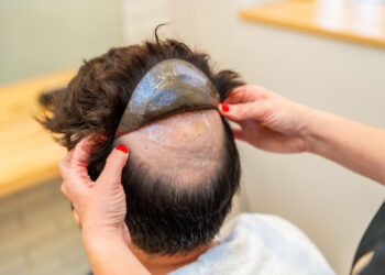 Injerto de cabello: entre la autoestima y la salud mental