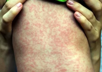 Confirman 12 muertes por sarampión