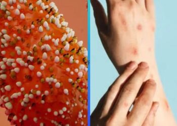 Confirman la primer muerte por Mpox en Jalisco