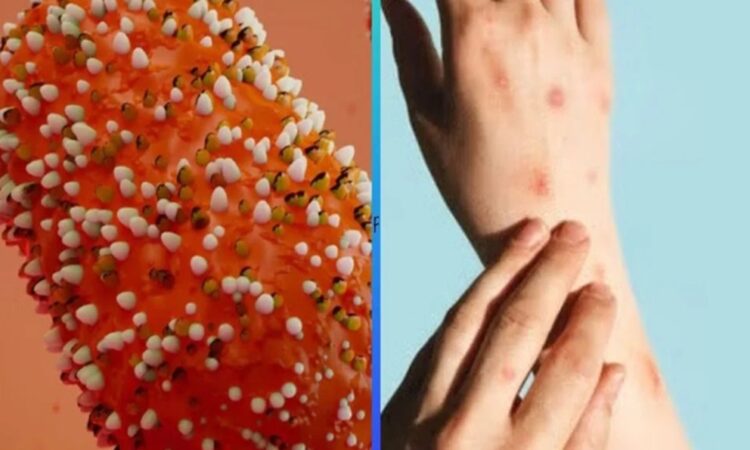 Confirman la primer muerte por Mpox en Jalisco