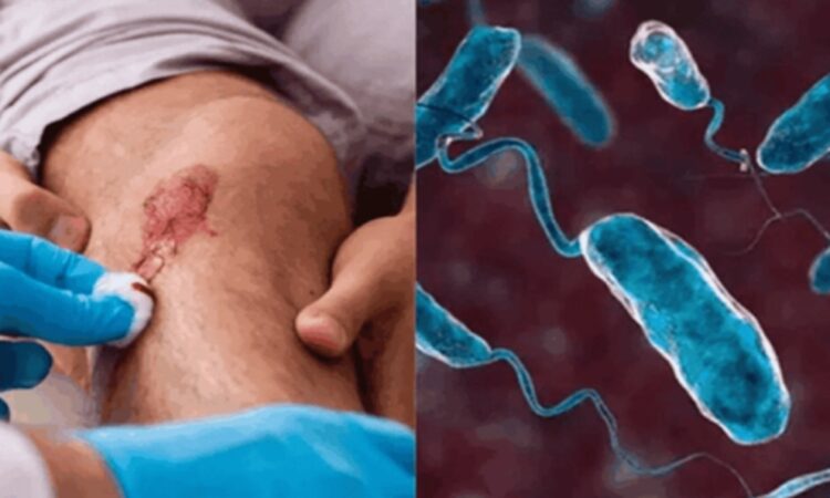 Alerta por bacteria carnívora en mariscos por aumento de muertes y contagios