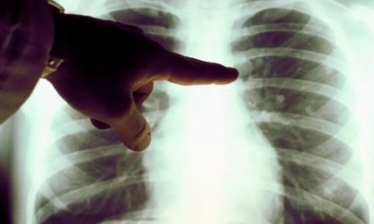 Muertes por cáncer en 2050 alcanzarán cifra récord mundial