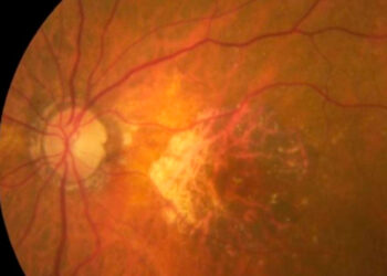 Avance médico: chip ocular devuelve la visión
