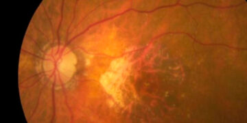 Avance médico: chip ocular devuelve la visión