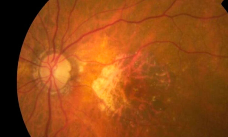 Avance médico: chip ocular devuelve la visión