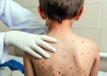 Alerta sanitaria en México: Casos de sarampión se disparan casi al doble en 2025