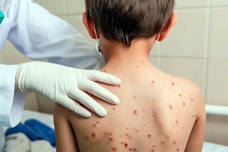 Alerta sanitaria en México: Casos de sarampión se disparan casi al doble en 2025