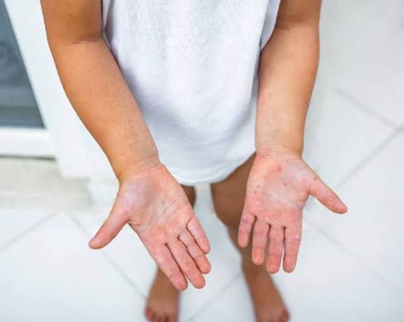 Descarta Salud alerta por virus Mano-Pié-Boca