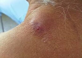 En alerta Sector Salud del sur de Tamaulipas ante posibles casos de miasis por gusano barrenador en humanos