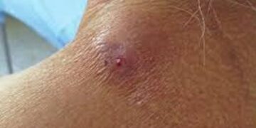 En alerta Sector Salud del sur de Tamaulipas ante posibles casos de miasis por gusano barrenador en humanos