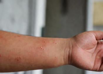 Suman 32 fallecimientos por sarampión en México