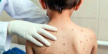 México registra el 71% de los contagios de sarampión en el continente americano