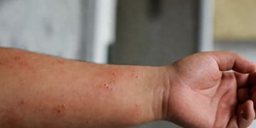 Suman 32 fallecimientos por sarampión en México