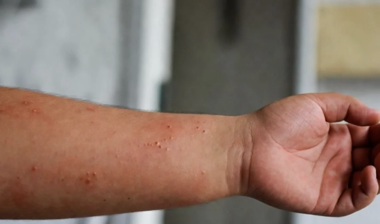 Suman 32 fallecimientos por sarampión en México