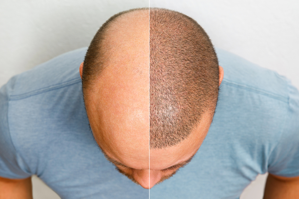 Hair Transplant in Mexico