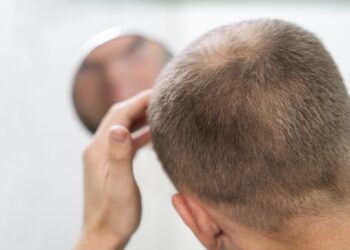 Calvicie masculina: cómo frenar la caída del cabello