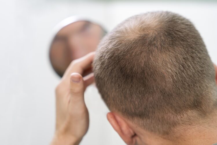 Calvicie masculina: cómo frenar la caída del cabello
