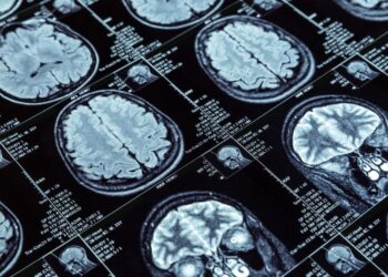 Desarrollan IA que reduce en 90% el tiempo de resonancias cerebrales