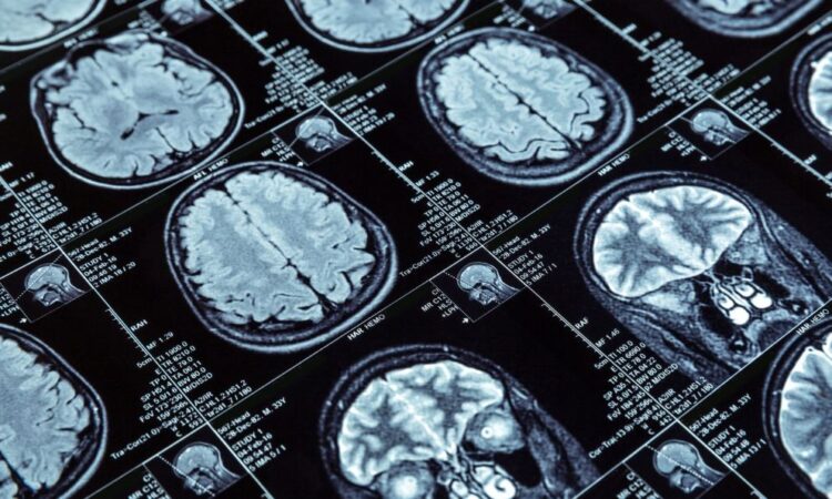 Desarrollan IA que reduce en 90% el tiempo de resonancias cerebrales
