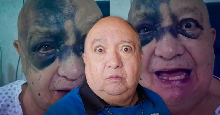 Luis de Alba se recupera tras accidente y lesiones en el rostro